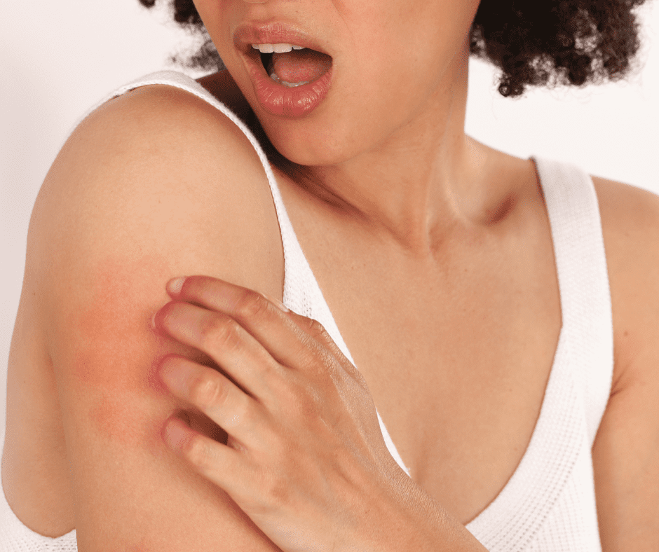 dermatite atopica o eczema come trattarlo
